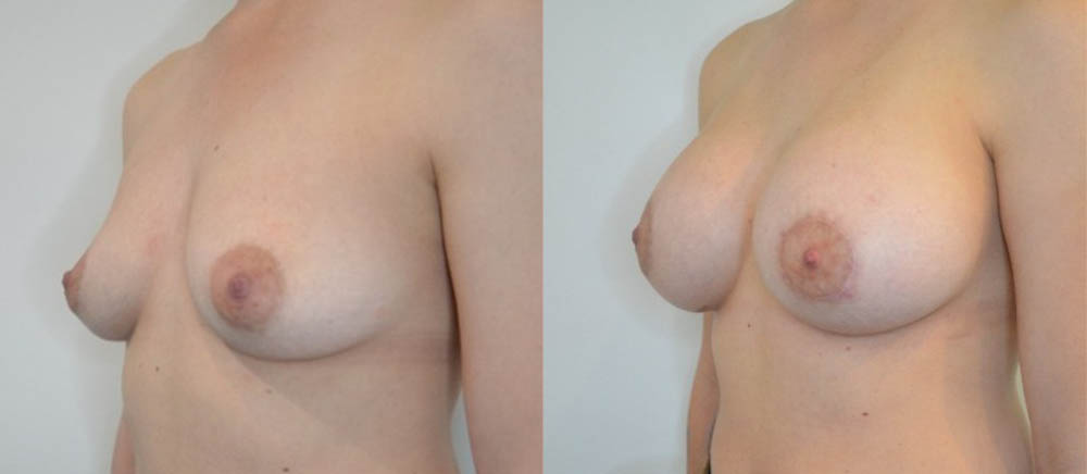 Breast Lift case #30786