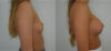 Breast Augmentation case #30805 slider thumbnail