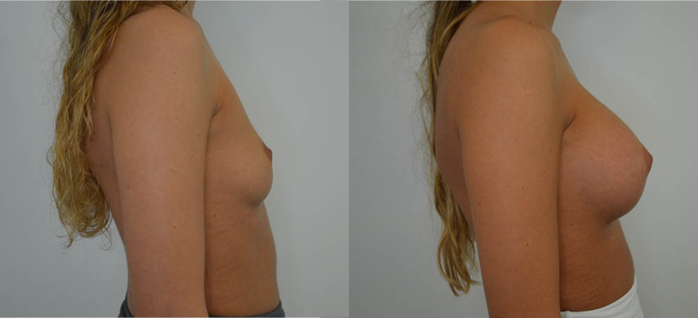 Breast Augmentation case #30805