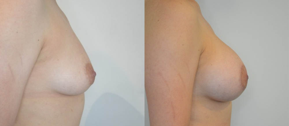 Breast Lift case #30786