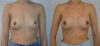 Breast Augmentation case #30811 slider thumbnail