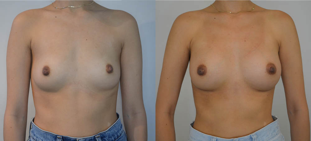 Breast Augmentation case #30811