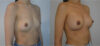 Breast Augmentation case #30811 slider thumbnail