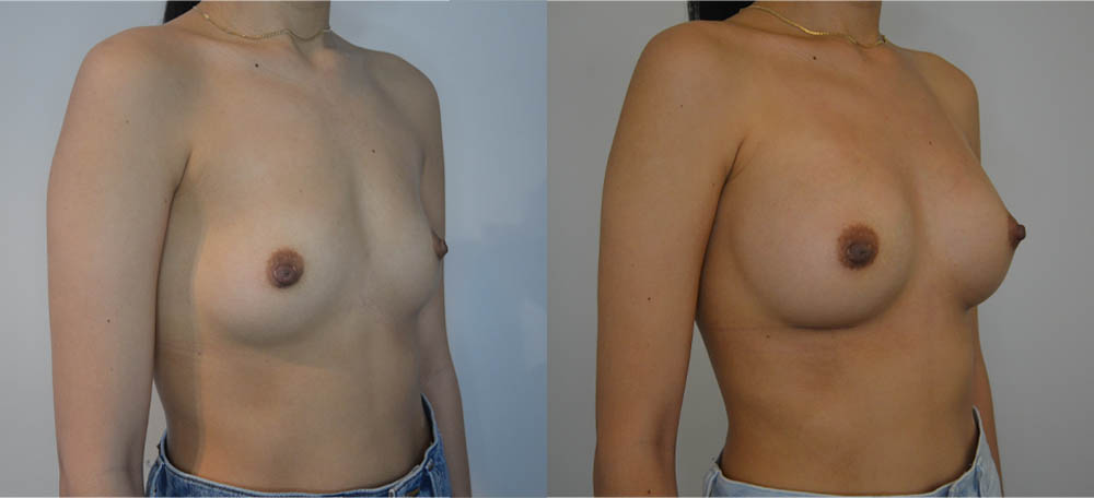 Breast Augmentation case #30811