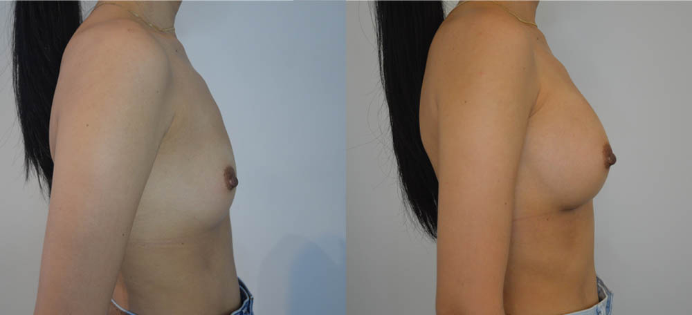 Breast Augmentation case #30811