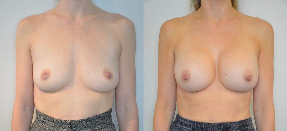 Breast Augmentation case #30815