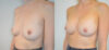 Breast Augmentation case #30815 slider thumbnail