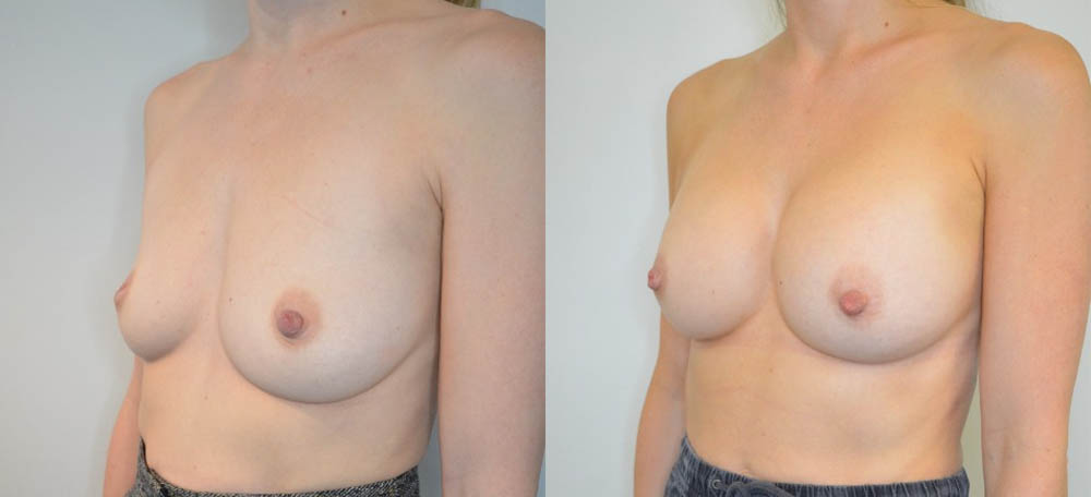 Breast Augmentation case #30815