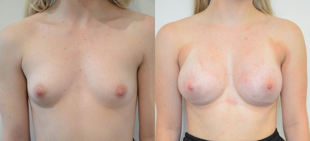 Breast Augmentation case #30818