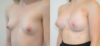 Breast Augmentation case #30818 slider thumbnail