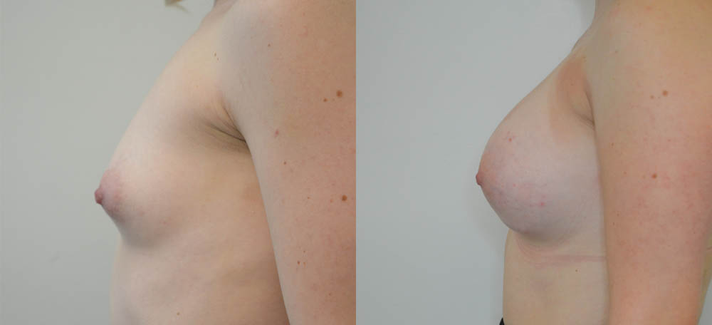 Breast Augmentation case #30818