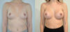 Breast Augmentation case #30822 slider thumbnail