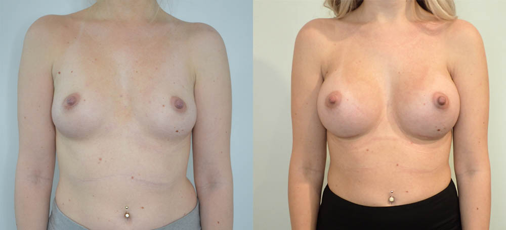 Breast Augmentation case #30822