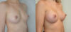 Breast Augmentation case #30822 slider thumbnail