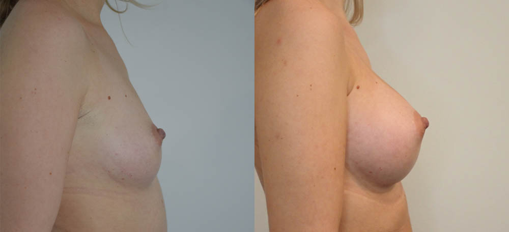 Breast Augmentation case #30822