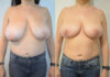 Breast Lift case #30782 slider thumbnail