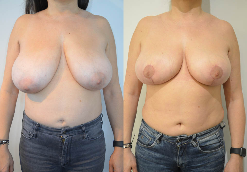 Breast Lift case #30782