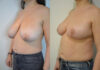 Breast Lift case #30782 slider thumbnail