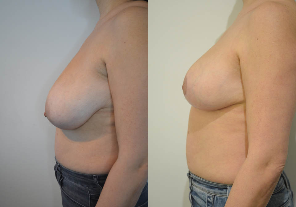 Breast Lift case #30782