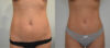 Liposuction case #30790 slider thumbnail