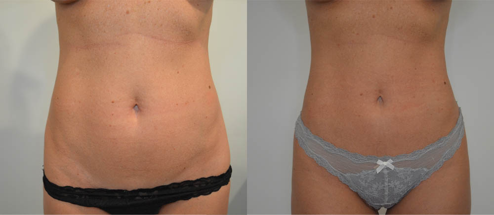 Liposuction case #30790