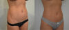 Liposuction case #30790 slider thumbnail