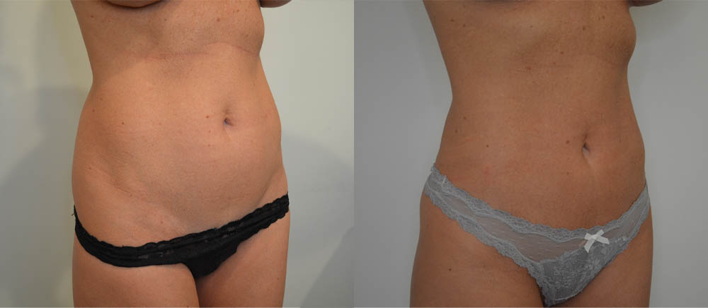 Liposuction case #30790