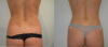 Liposuction case #30790 slider thumbnail