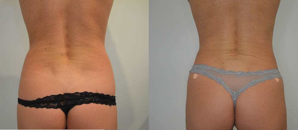 Liposuction case #30790