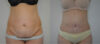 Tummy Tuck case #30794 slider thumbnail