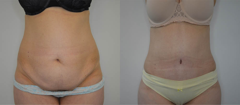 Tummy Tuck case #30794