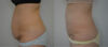 Tummy Tuck case #30794 slider thumbnail