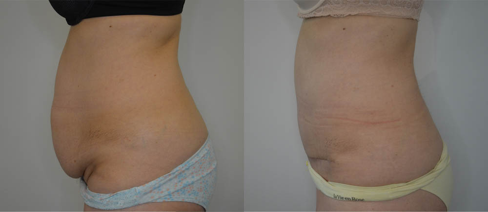 Tummy Tuck case #30794