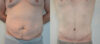 Tummy Tuck case #30797 slider thumbnail