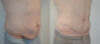 Tummy Tuck case #30797 slider thumbnail