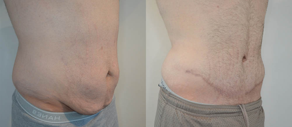 Tummy Tuck case #30797