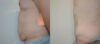 Tummy Tuck case #30797 slider thumbnail