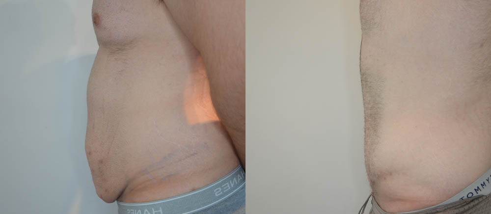 Tummy Tuck case #30797