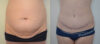 Tummy Tuck case #30801 slider thumbnail