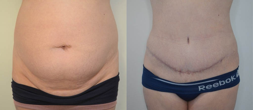 Tummy Tuck case #30801