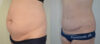 Tummy Tuck case #30801 slider thumbnail