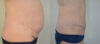 Tummy Tuck case #30801 slider thumbnail