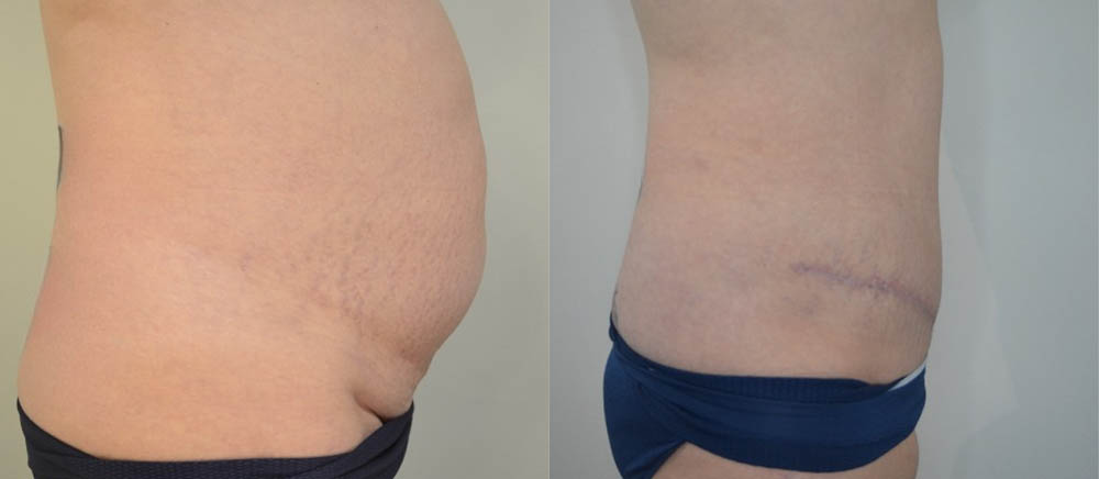 Tummy Tuck case #30801