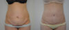 Tummy Tuck case #35798 slider thumbnail