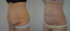 Tummy Tuck case #35798 slider thumbnail