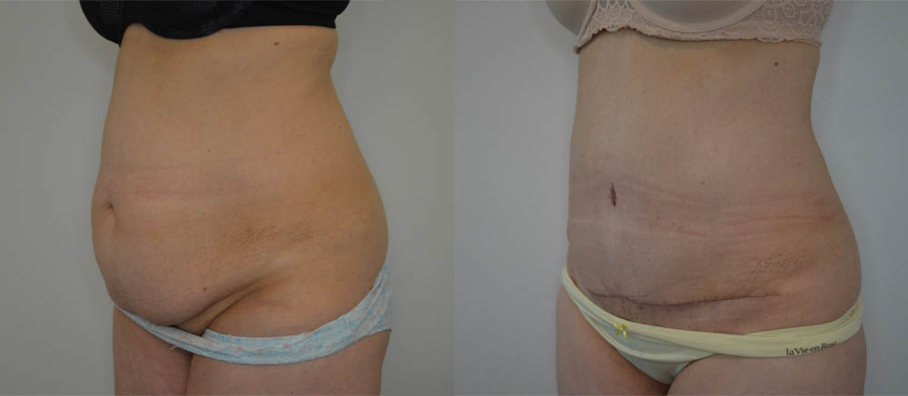 Tummy Tuck case #35798