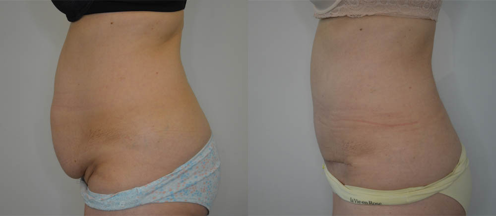Tummy Tuck case #35798