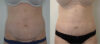 Tummy Tuck case #35802 slider thumbnail