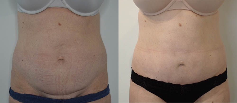 Tummy Tuck case #35802
