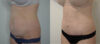 Tummy Tuck case #35802 slider thumbnail